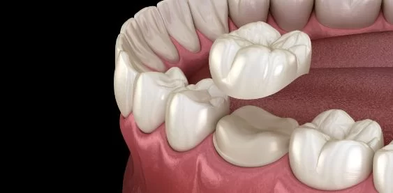 Same-Day Crowns and Fillings: Fast and Reliable Dental Solutions