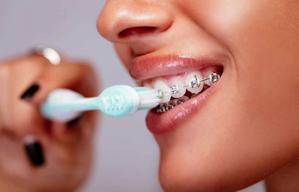 Caring for Your Teeth After Orthodontic Treatment: Essential Tips for Maintaining a Healthy Smile