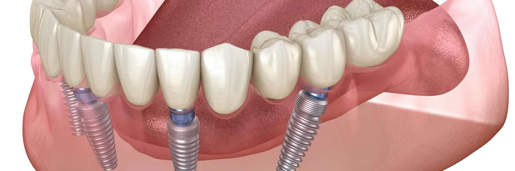 How to Choose Between Dentures and Dental Implants: Which is Best for You?