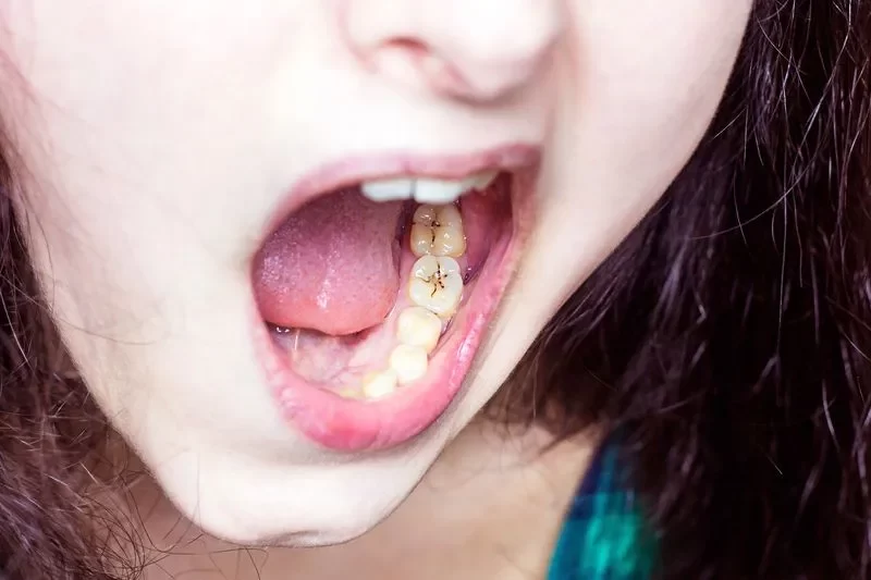 Prevention and Treatment of Cavities: A Complete Guide