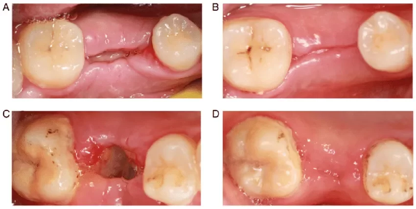 What to Expect After a Tooth Extraction: Complete Guide for Recovery