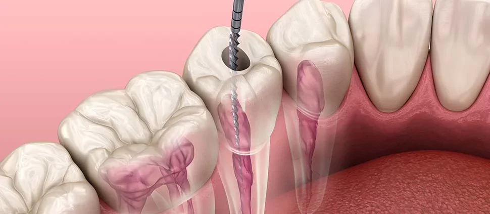 How to Restore Teeth After Root Canal: A Complete Guide