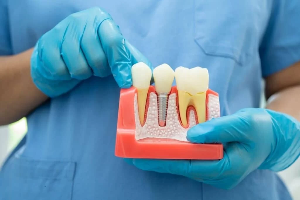 Periodontists Specializing in Implant Dentistry: Expert Care for Dental Implants