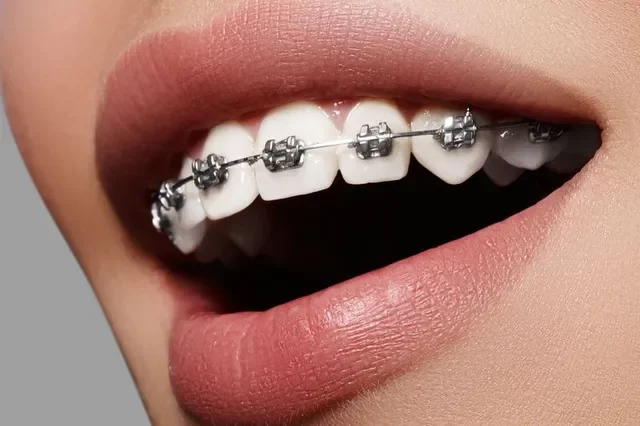 Oral Health for People with Braces: Essential Tips and Care