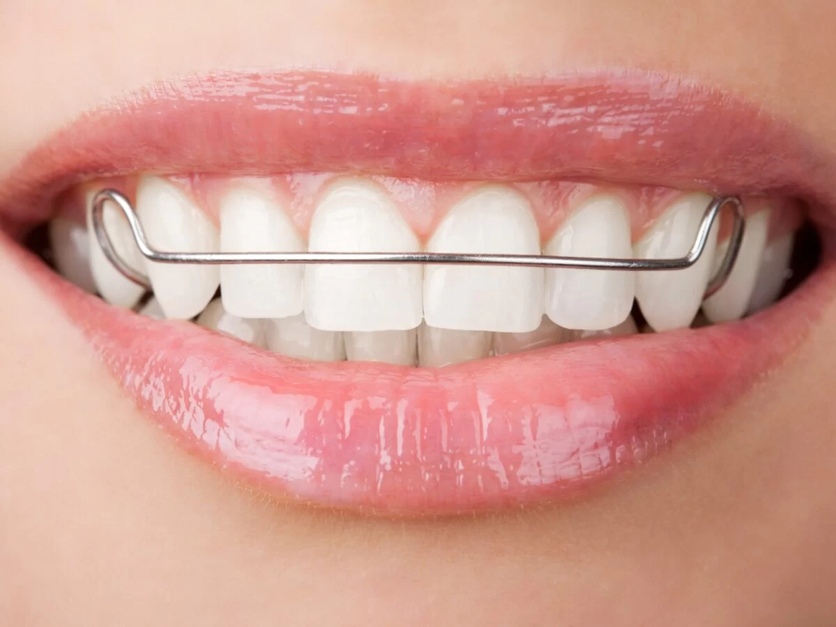 How to Maintain Teeth While Wearing Retainers: Tips for Healthy Smiles