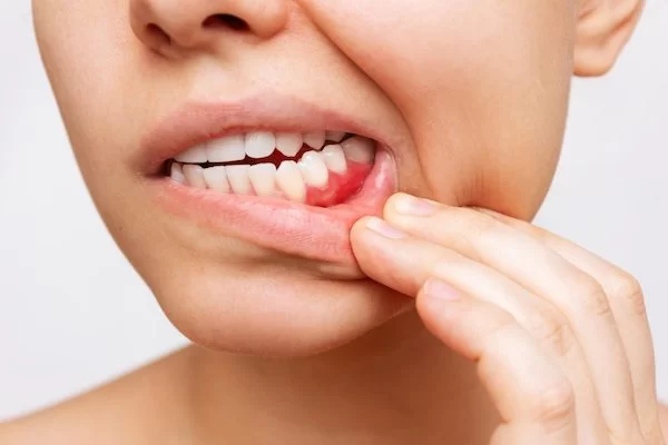 Understanding Tooth Abscess: Causes, Symptoms, and Treatment Options