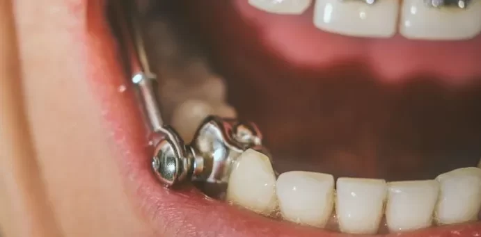 How Dental Appliances Help Fix Bite Misalignments: Essential Solutions for Better Oral Health