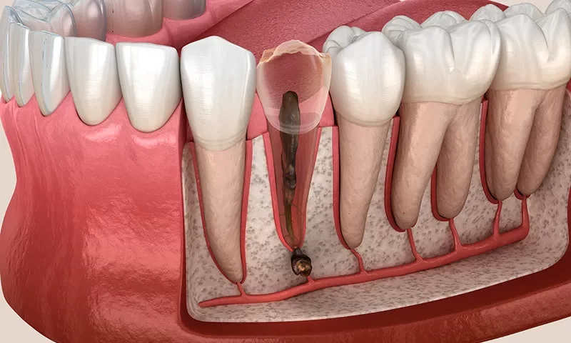 Root Pain: Causes, Treatments, and Solutions for Tooth Root Sensitivity