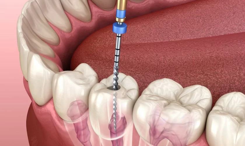 Pulp Restoration: Restoring Your Tooth Health with Advanced Dental Techniques