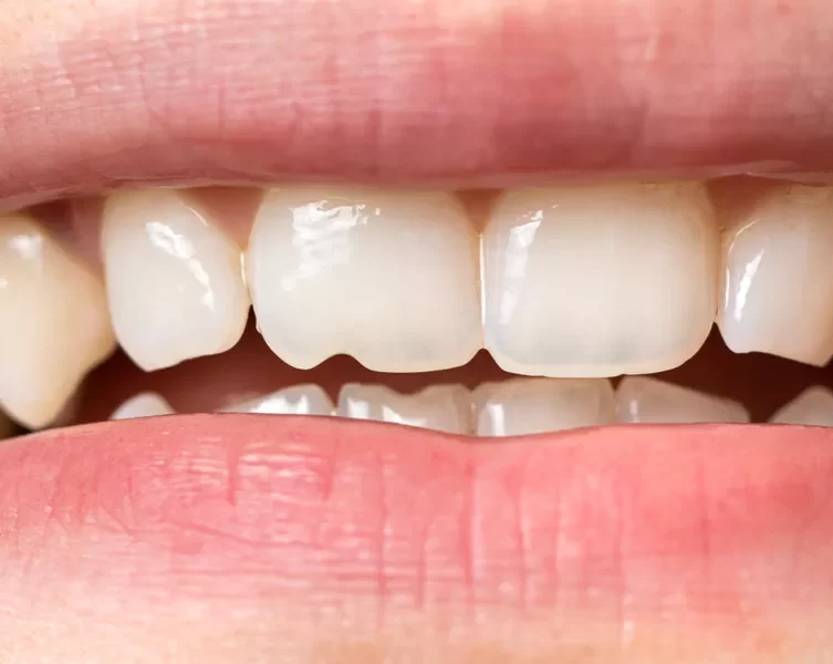 Rapid Care for Cracked or Chipped Teeth: Immediate Solutions and Treatments