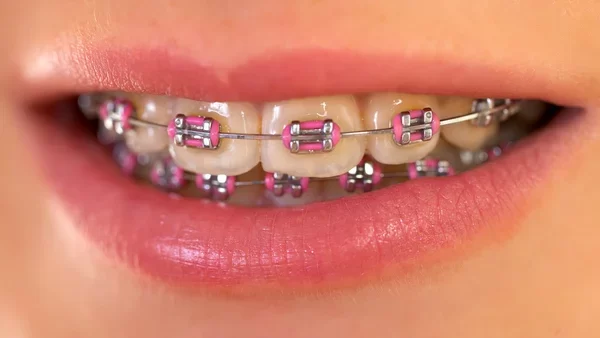 Traditional Metal Braces: The Complete Guide to Orthodontic Treatment and Benefits