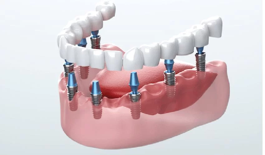 What Are the Benefits of Dental Implants? Why They Are the Best Solution for Tooth Replacement