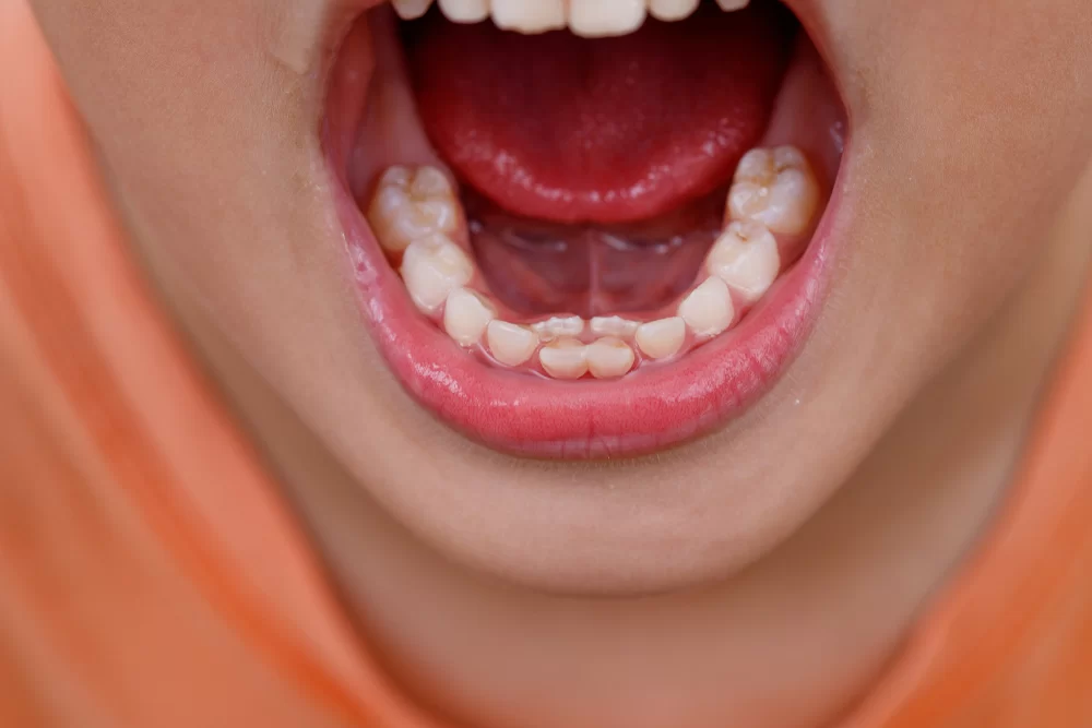 The Best Treatment for a Knocked-Out Tooth: Essential Steps for Fast Recovery