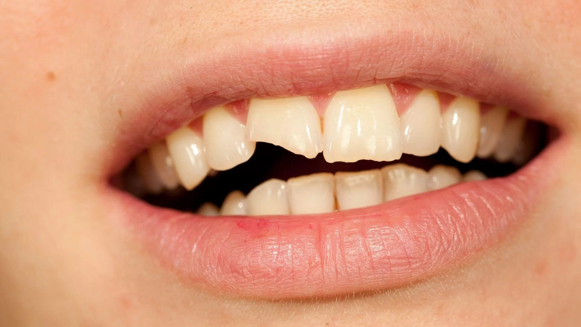 Tooth Decay Treatment for Cracked Teeth: Effective Solutions for a Healthier Smile