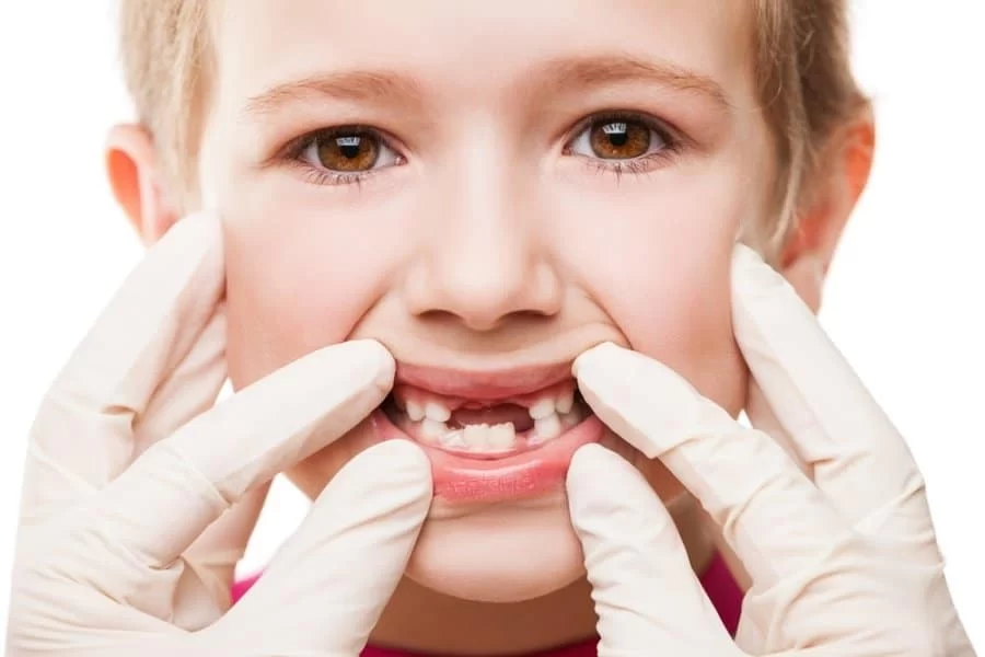 How Tooth Decay Affects Teeth in Children: A Guide for Parents