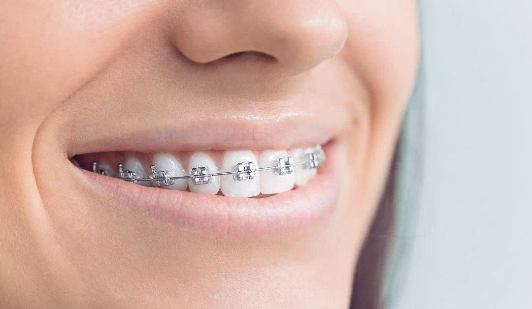 What is the Best Age to Get Braces? – Guide to Orthodontic Treatment