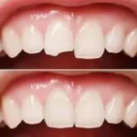 How to Reverse Tooth Decay: Effective Strategies for Restoring Your Smile