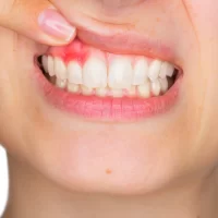 What Are the Signs of a Dental Abscess? Understanding the Symptoms and Treatment Options