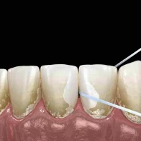 Can Toothpaste with Fluoride Reverse Tooth Decay? Exploring the Truth Behind Fluoride and Cavities