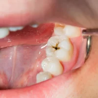 How Often Should You Check for Cavities?