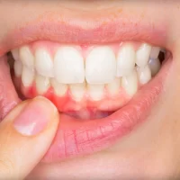 Causes of Periodontal Disease and How to Prevent It