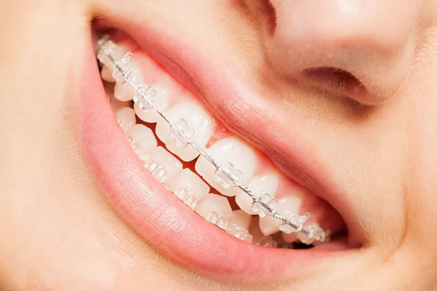 Ceramic Braces vs Metal Braces: Which One is Right for You?