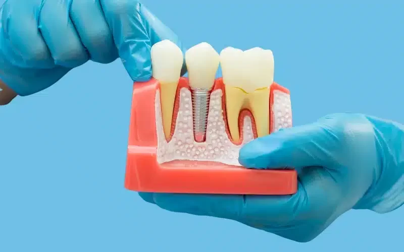 How to Prevent Dental Implant Failure: Essential Tips for Long-Term Success