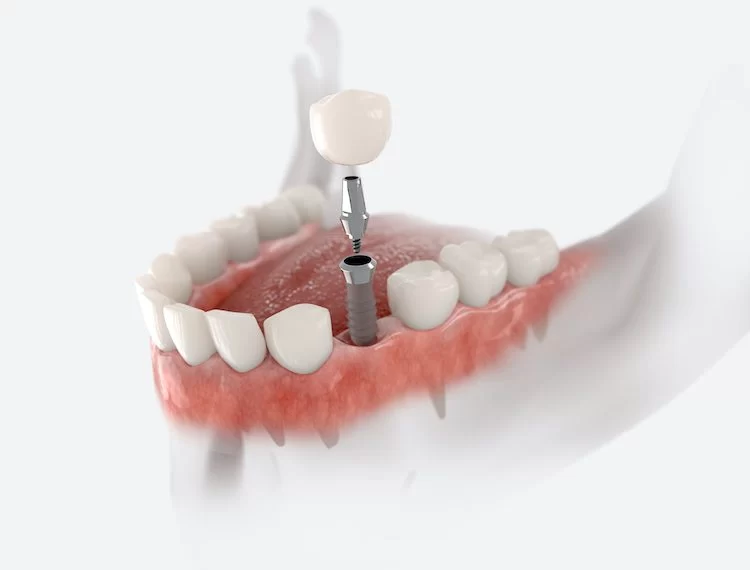 How Do Dental Implants Integrate with the Jawbone? Understanding the Fusion Process