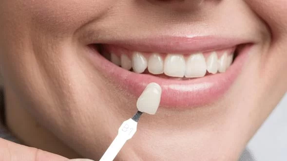 How Much Do Porcelain Veneers Cost? Understanding the Price and What to Expect