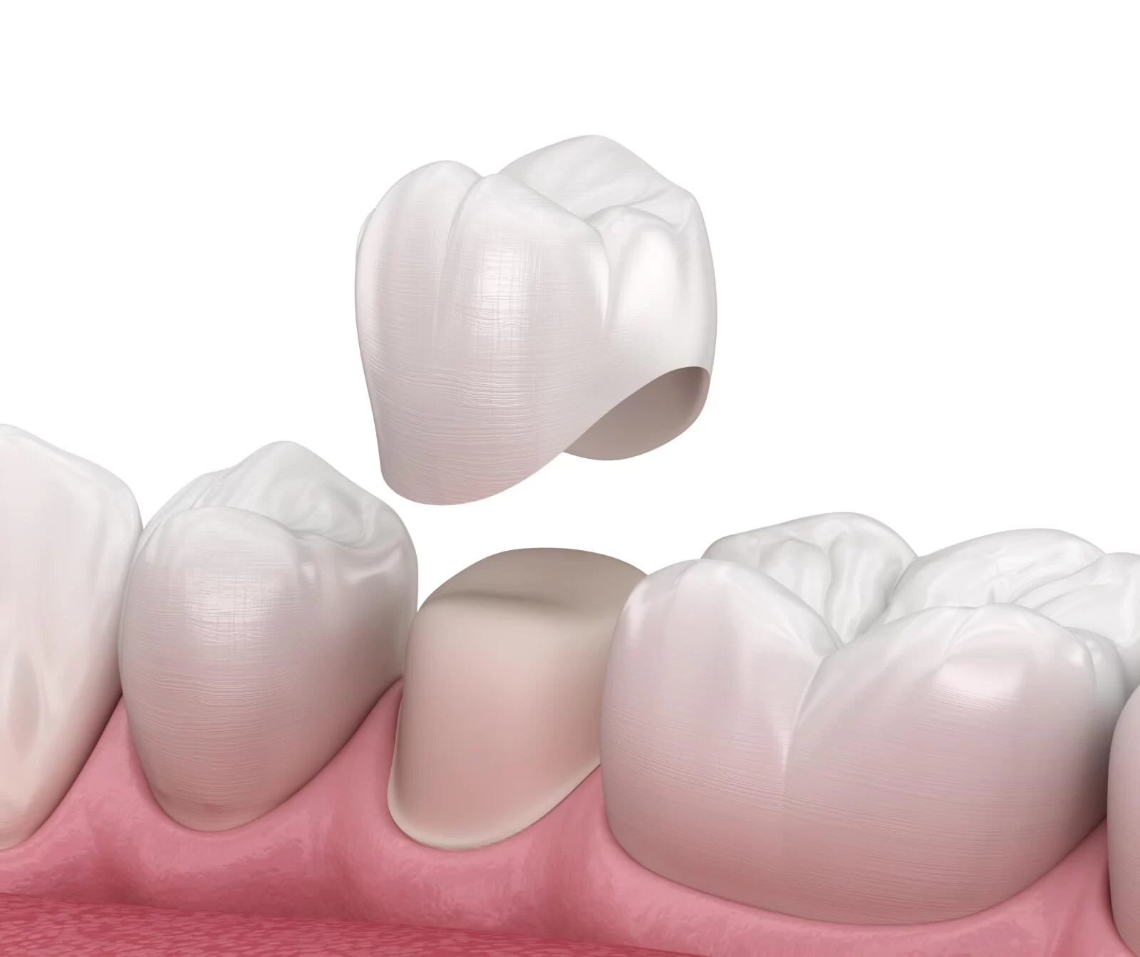 What Is the Difference Between a Dental Crown and a Dental Veneer? Exploring Key Differences