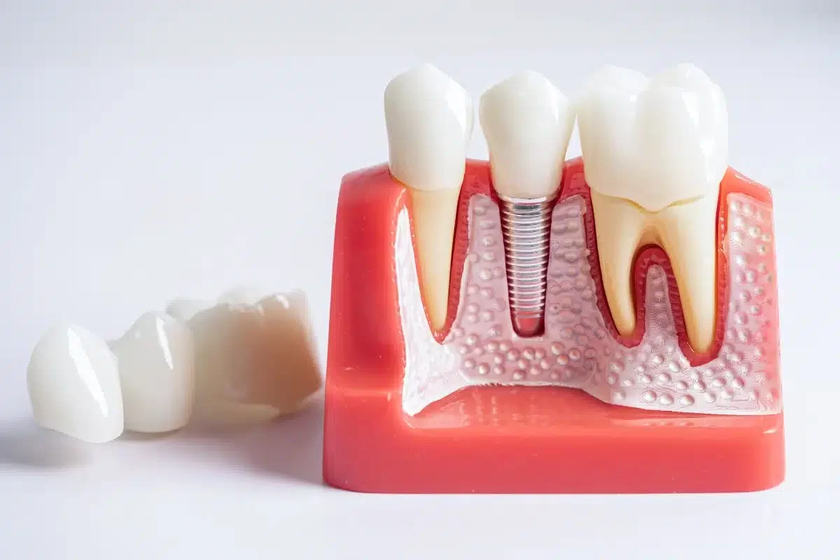 How Long Does It Take for Dental Implants to Heal? Full Recovery Timeline