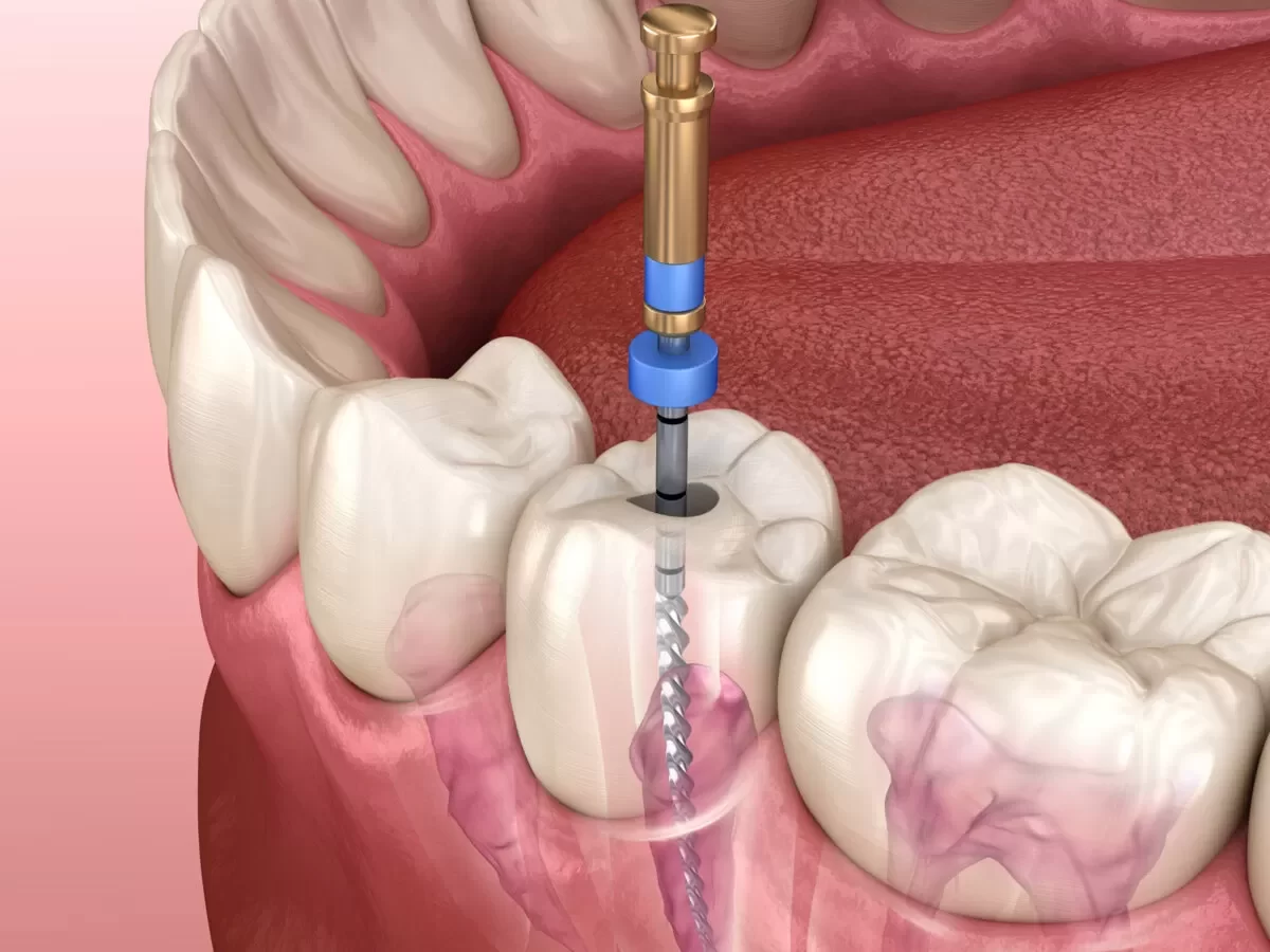 How Painful Is a Root Canal? What You Need to Know About Root Canal Treatment Pain