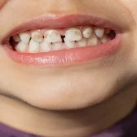 What Causes Black Spots on Teeth and How to Treat Them: A Comprehensive Guide