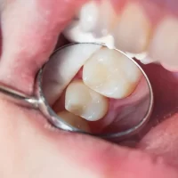 How to Treat a Sore Tooth After a Filling: Effective Remedies and Solutions