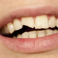 How to Fix a Cracked Tooth