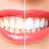 How to Whiten Teeth with Baking Soda Safely: Effective and Natural Teeth Whitening