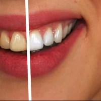 How to Stop Teeth from Becoming Stained Over Time