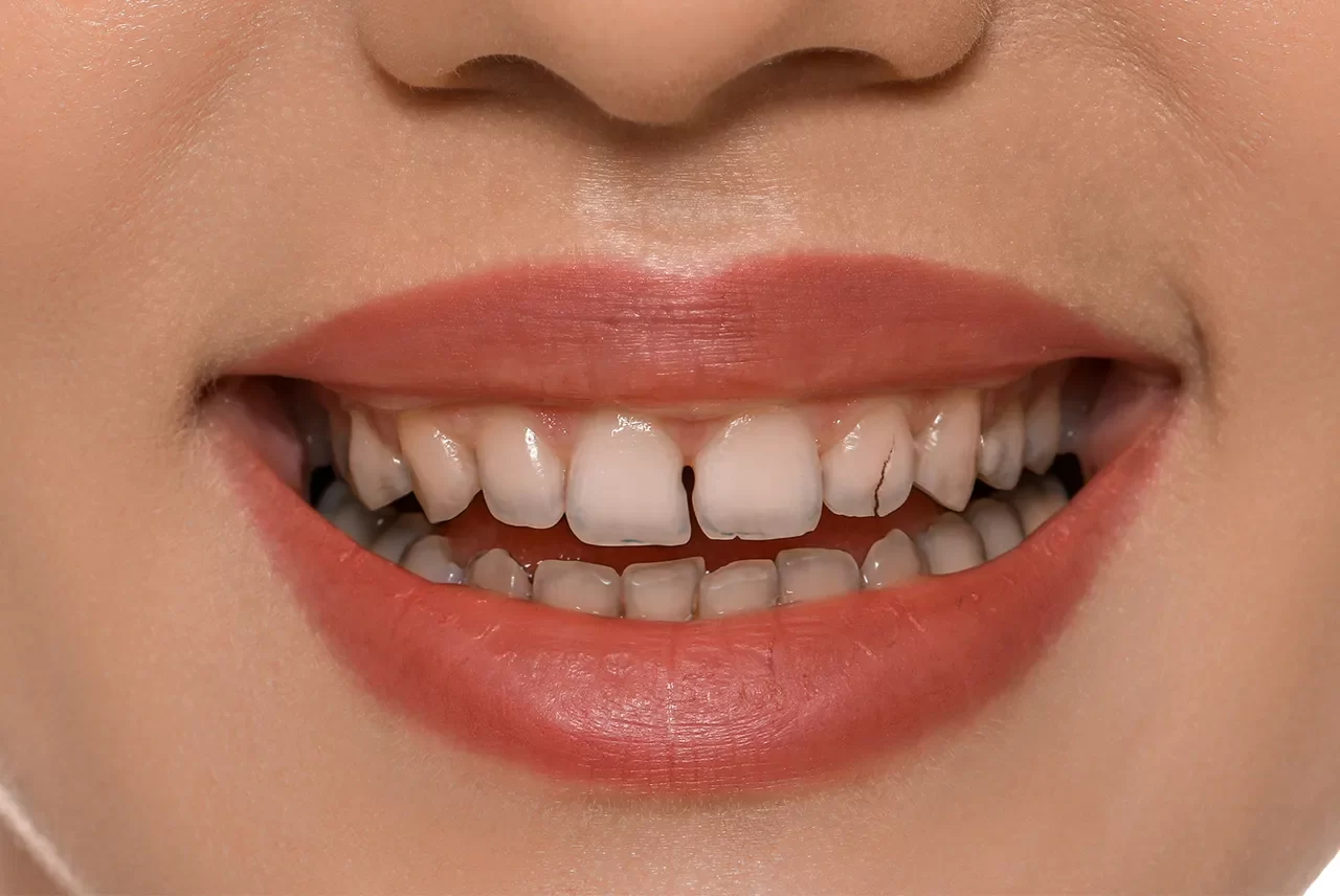 How to Fix a Chipped Tooth at Home: Easy and Effective Solutions