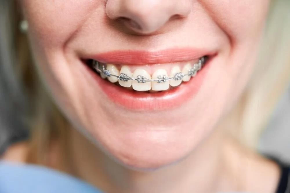 Choosing the Right Type of Braces: Which Option is Best for You?