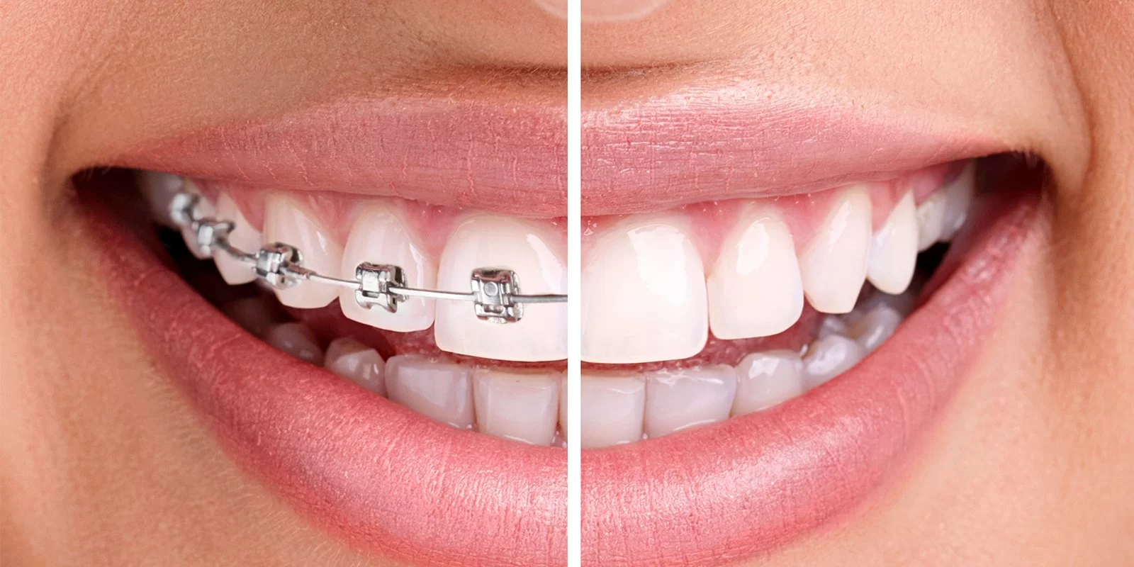 The Role of Orthodontics in Improving Oral Health