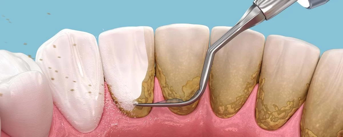 How to Reduce Plaque Buildup on Teeth Naturally: Effective Tips and Solutions