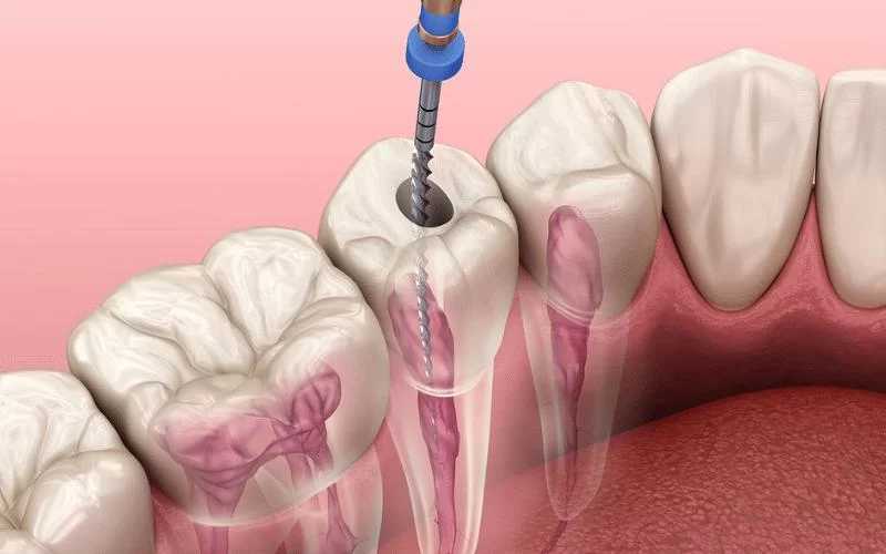 Tooth Restoration After Root Canal Treatment: Your Complete Guide to Post-Treatment Options