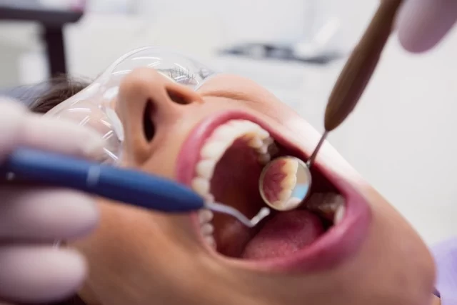 Best Dental Materials for Fillings: Choosing the Right Solution for Your Smile