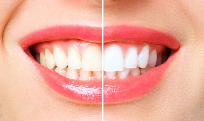Teeth Whitening and Restoration: A Comprehensive Guide to Achieving a Brighter Smile