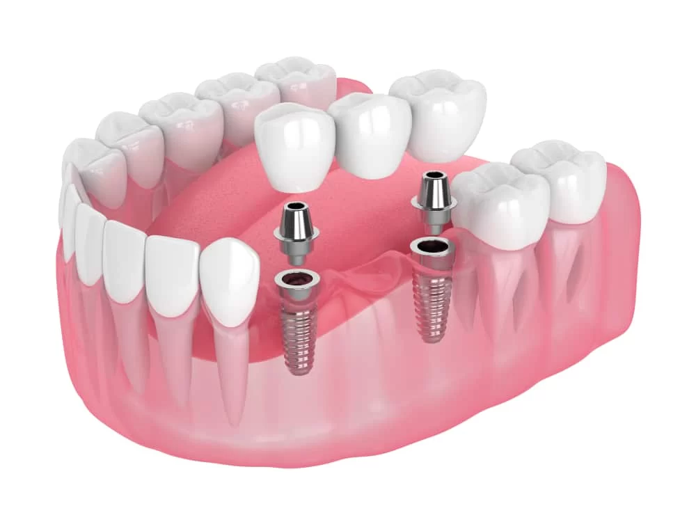 Dental Bridges for Severe Tooth Decay: A Reliable Solution for Restoration