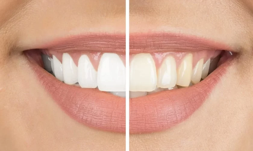 Best Practices for Teeth Whitening at Home: Effective Tips for a Brighter Smile