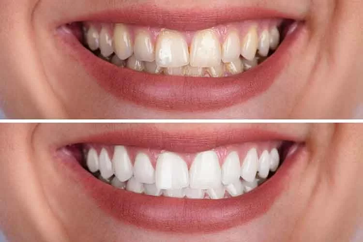 How to Get Rid of Yellow Teeth: Proven Tips and Treatments