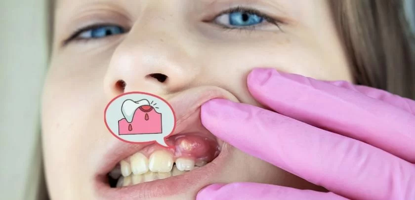 What Are the Symptoms of a Root Canal Infection? Identifying the Signs Early