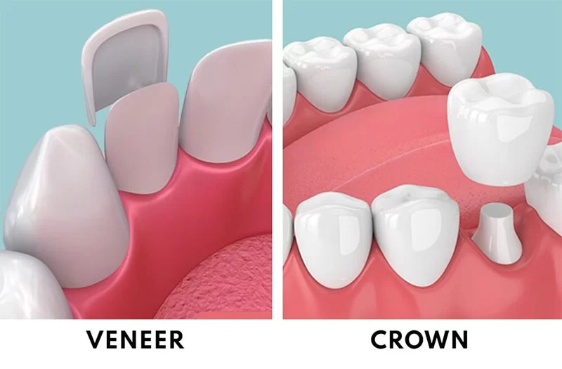 What is the Difference Between a Crown and a Veneer? – Understanding Dental Options