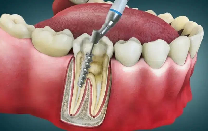 What is Root Canal Therapy and Why is it Necessary?